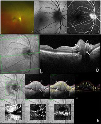 Clinical and Multi-Mode Imaging Features of Eyes With Peripapillary Hyperreflective Ovoid Mass-Like Structures